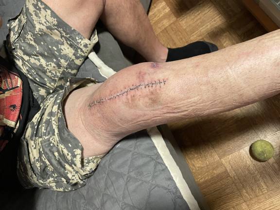 Robert Annunziato’s leg 13 days post-surgery. After his motorcycle accident, a month-long wait for approval from his insurance for an MRI led to severe muscle atrophy.