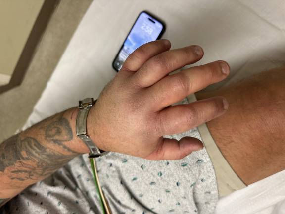 Parker Space’s hand when he arrived at Newton Medical Center after a massasauga rattlesnake bite.
